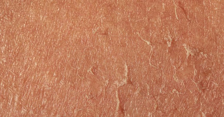 An extreme closeup view on the flaky skin of an aging caucasian person. Shedding and peeling skin fills the frame creating textured background